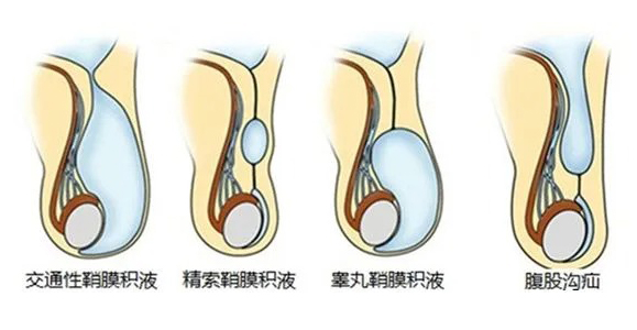 主要分为精索鞘膜积液