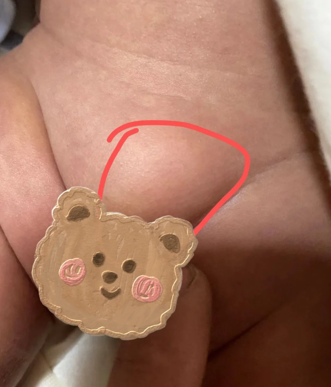 对于 6 个月以上的孩子而言,疝气基本不存在自愈的可能性