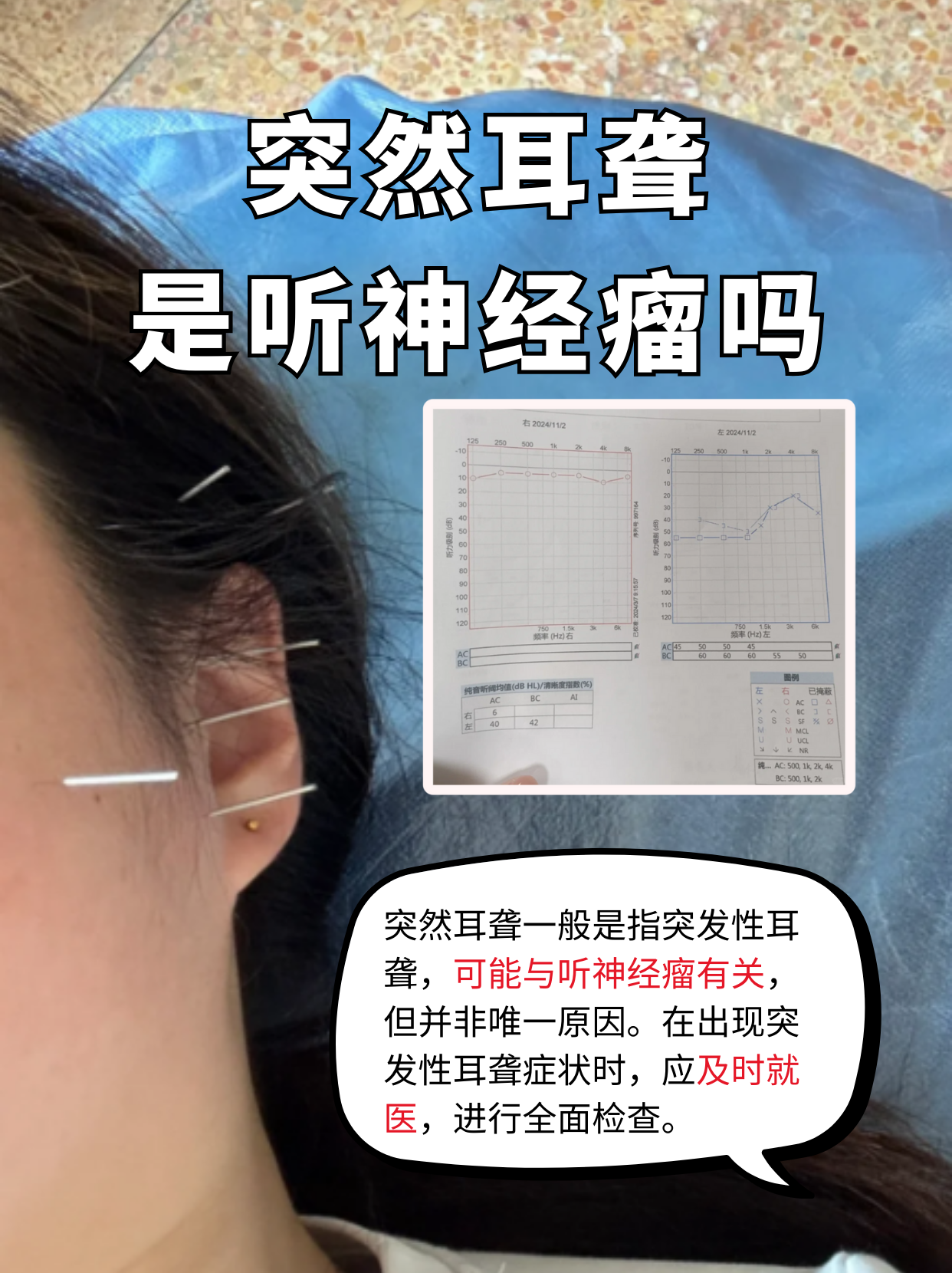 突发性耳聋是一种原因不明的,突然发生的感觉神经性耳聋,其发病比较