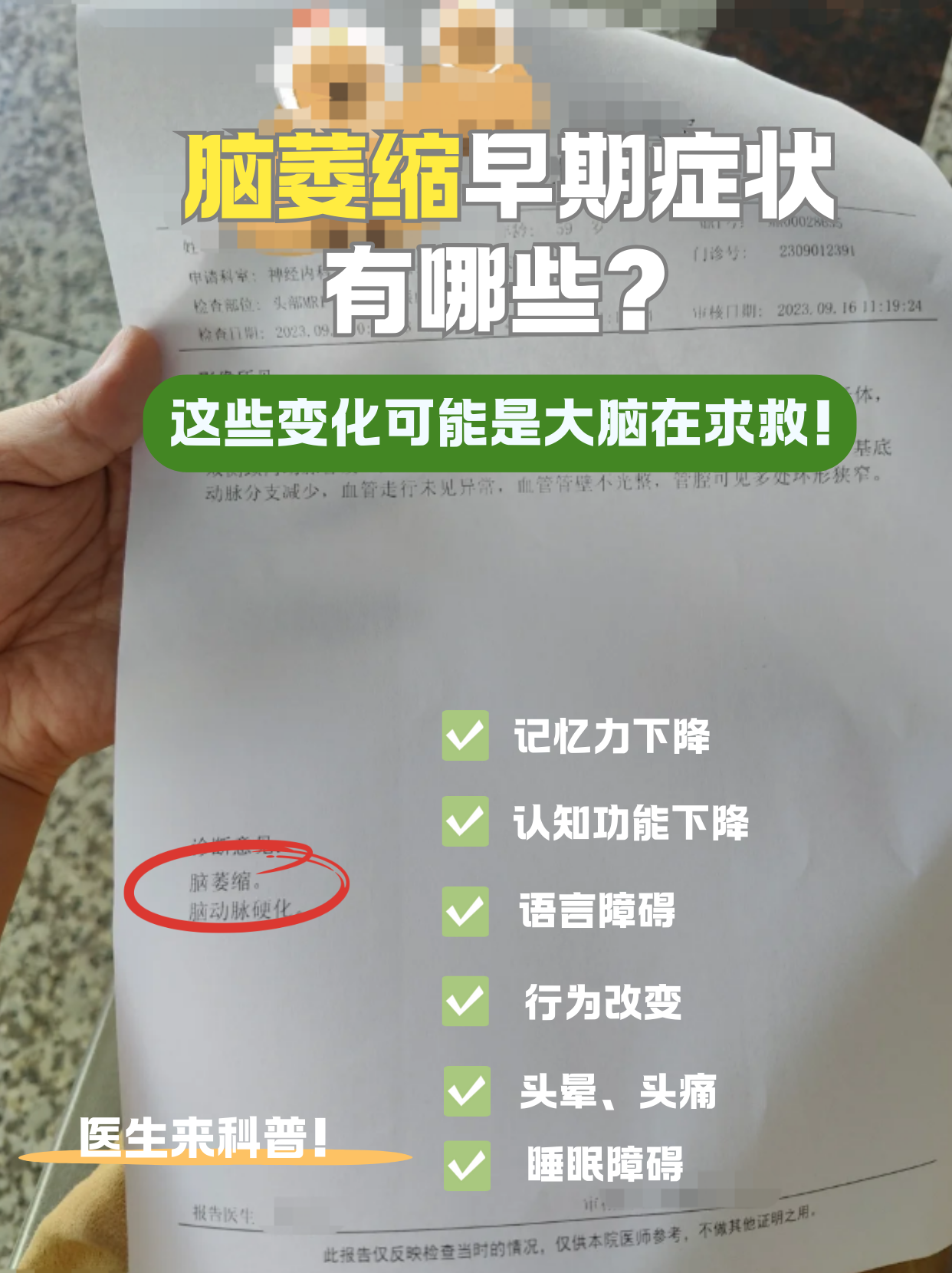 脑萎缩是一种慢性进行性疾病,其早期症状可能因人而异,但通常包括