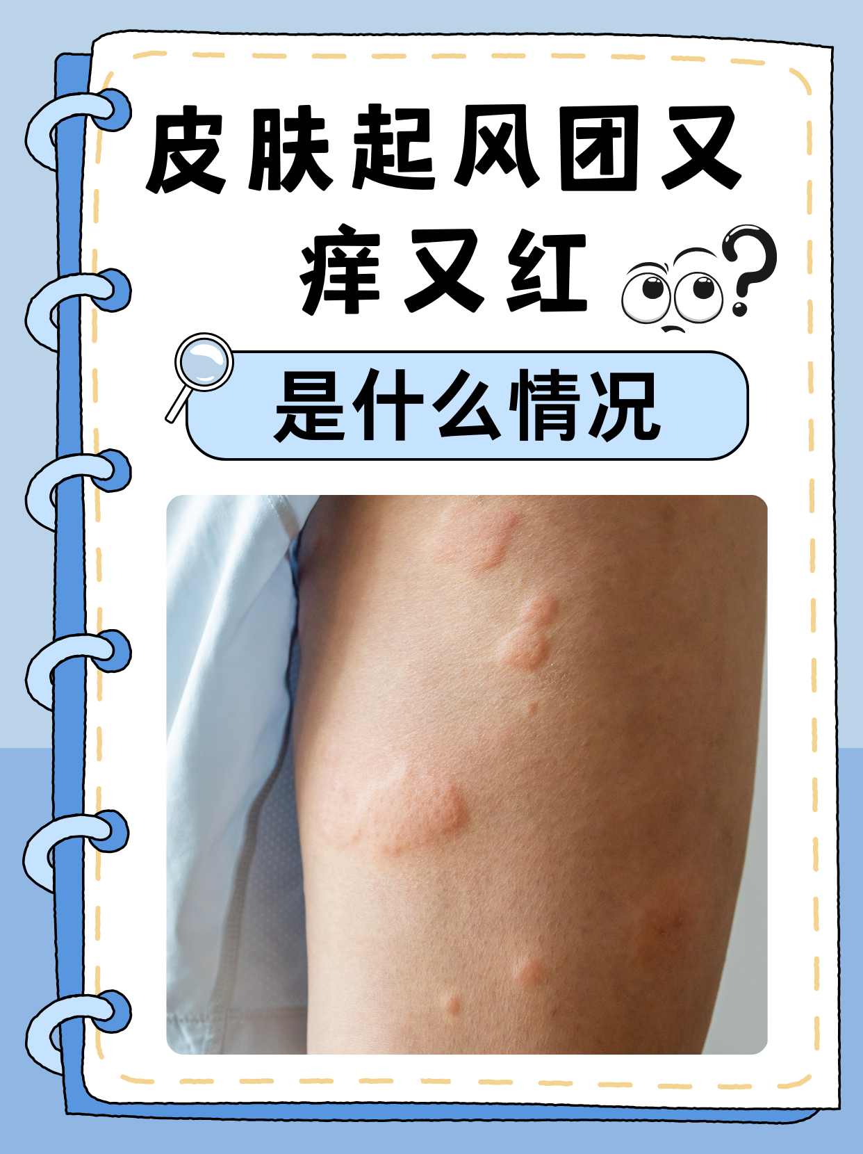 这些此起彼伏的红色隆起,就是医学上所说的荨麻疹