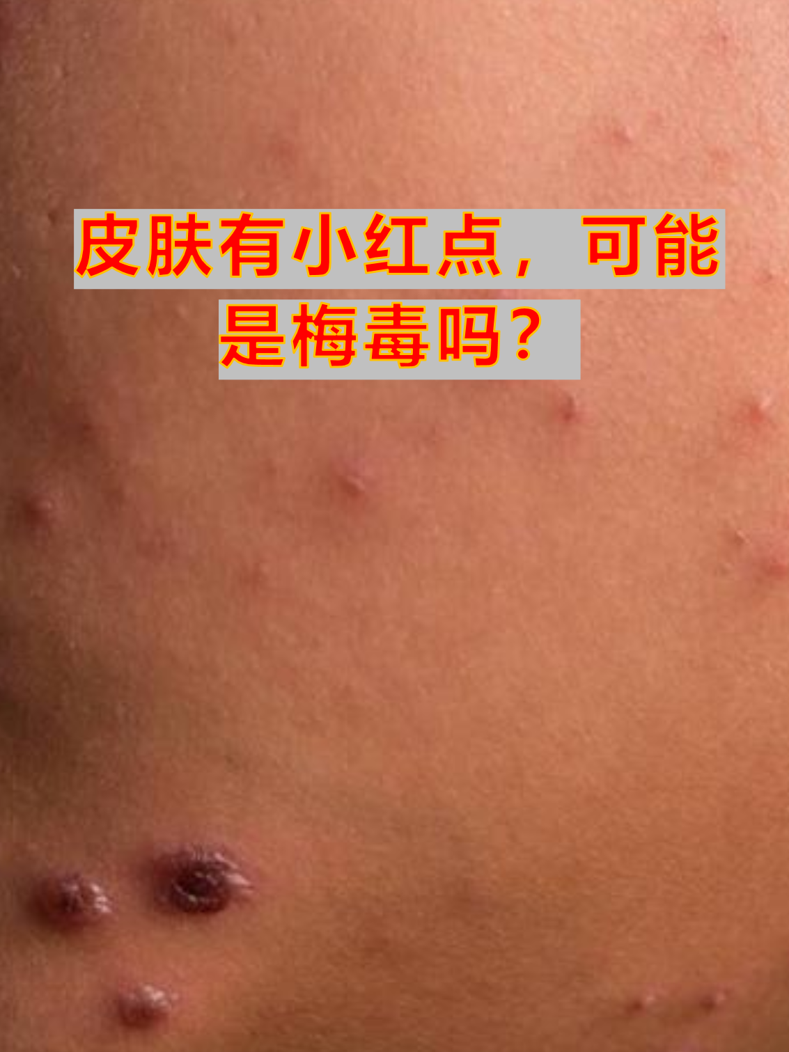 皮肤有小红点,可能是梅毒吗