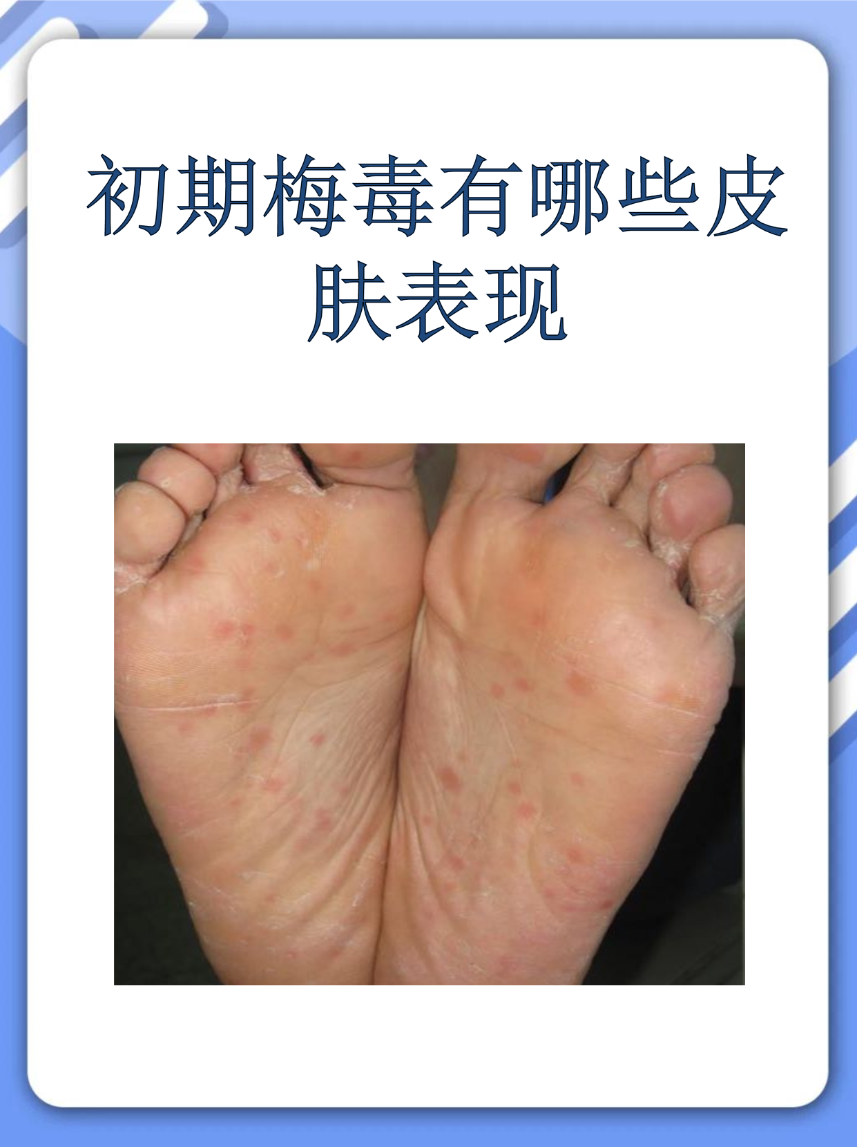 初期梅毒有哪些皮肤表现