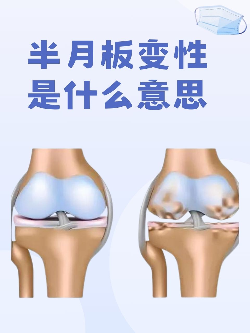 半月板变性是什么意思