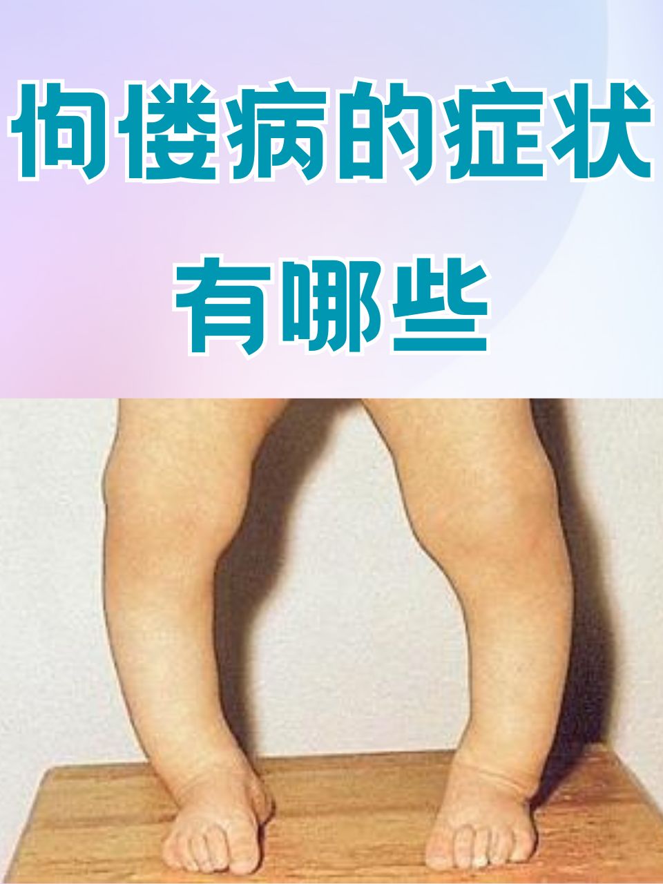 佝偻病的症状有什么?