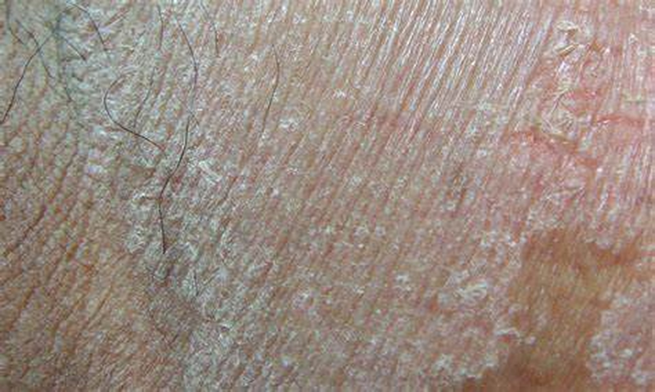 在门诊患者中,常见青中年男性,因为阴囊潮湿伴有异味前来就诊