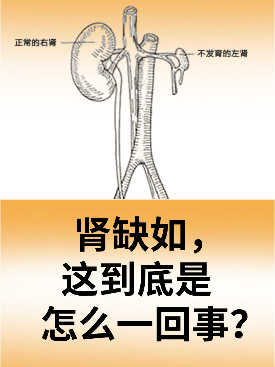 肾缺如,又称为肾脏发育不全或肾脏缺失,是一种罕见的出生缺陷