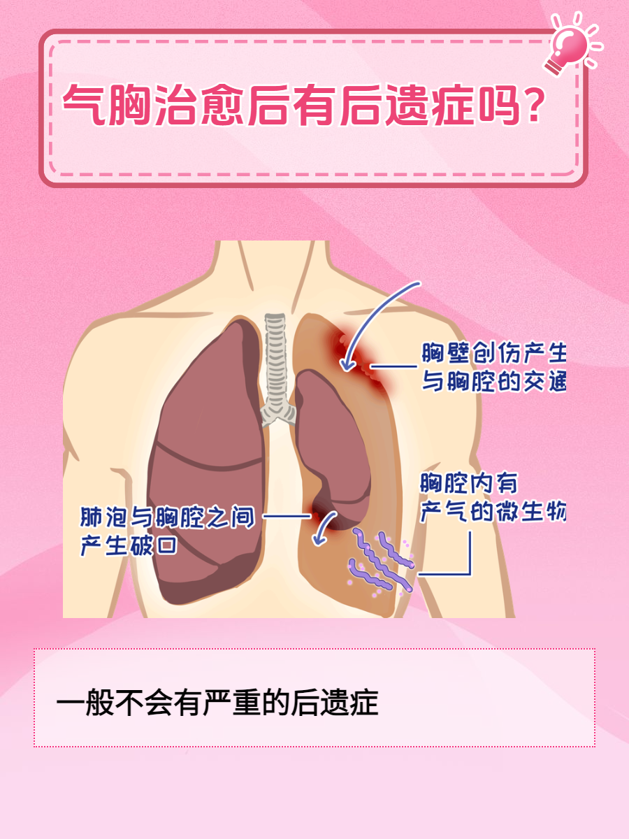 三种气胸的图片图片