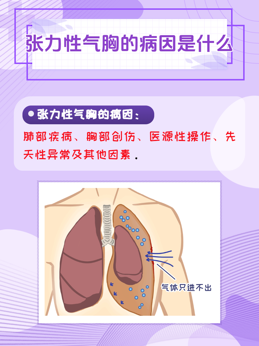 张力性气胸患者图片