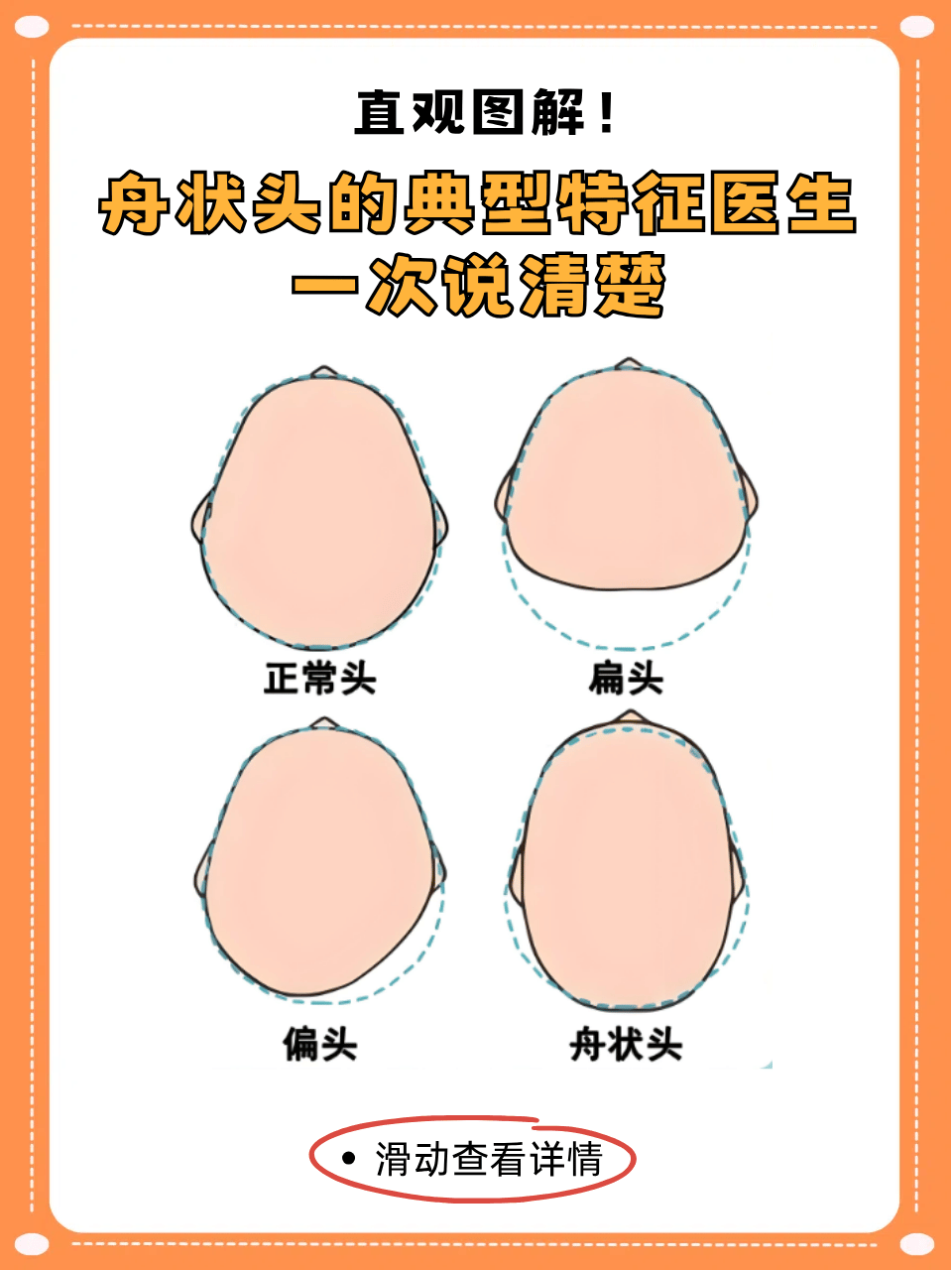 真正的舟状头特征解析 头型轮廓