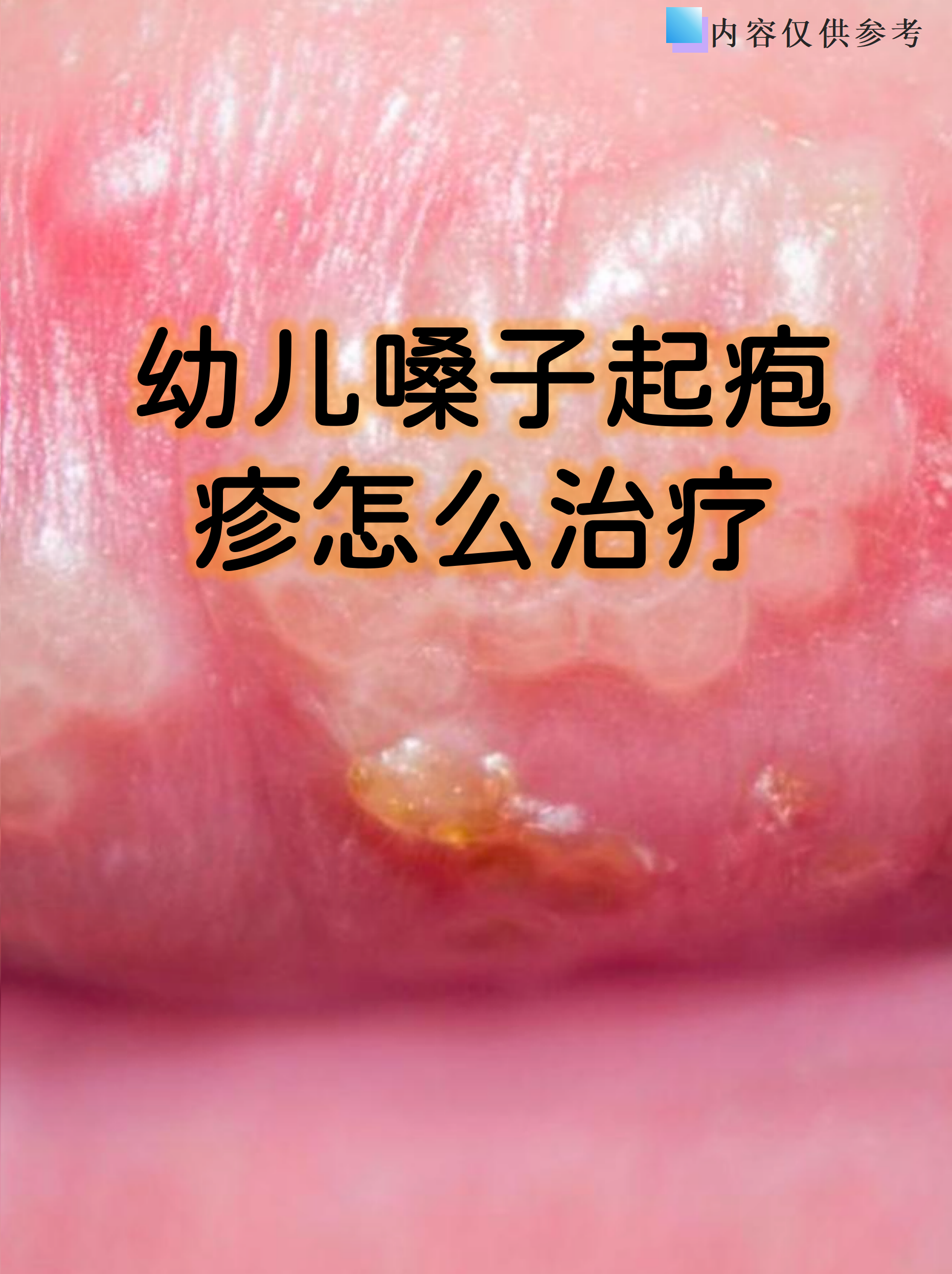 幼儿嗓子起疱疹怎么治疗