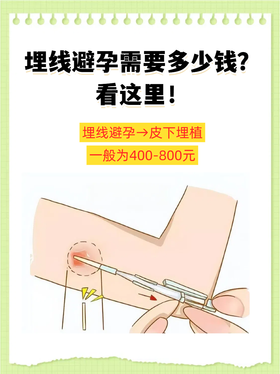埋线避孕需要多少钱?看这里!