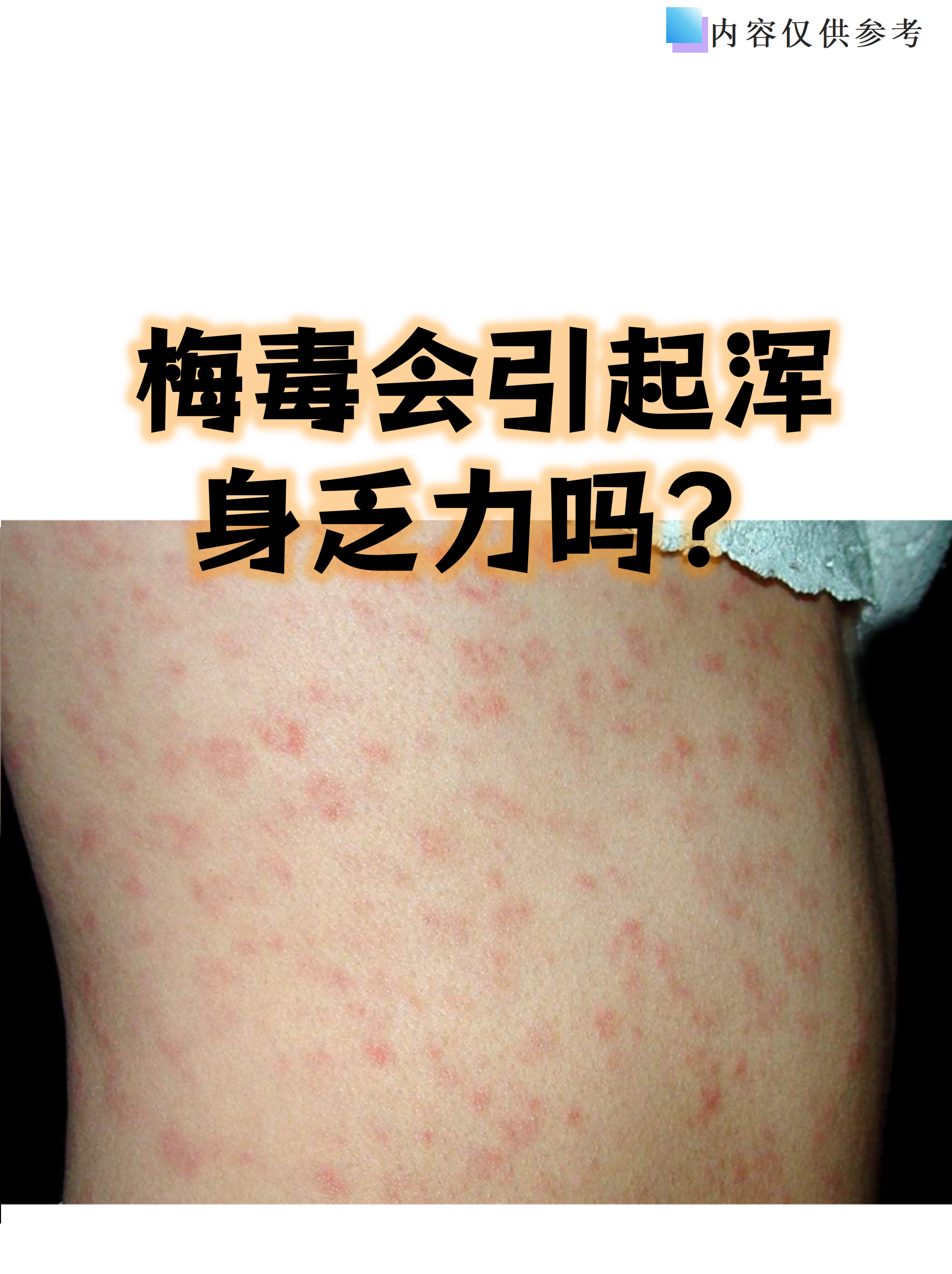 梅毒确实可能让人感到疲惫不堪,这种乏力感往往与免疫系统被激活有