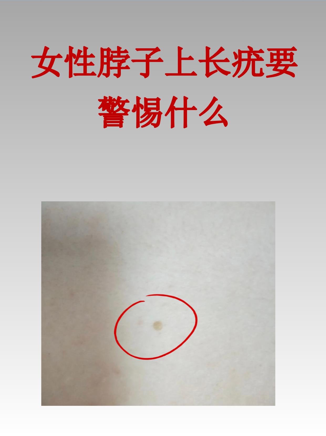 女性脖子上长疣要警惕什么