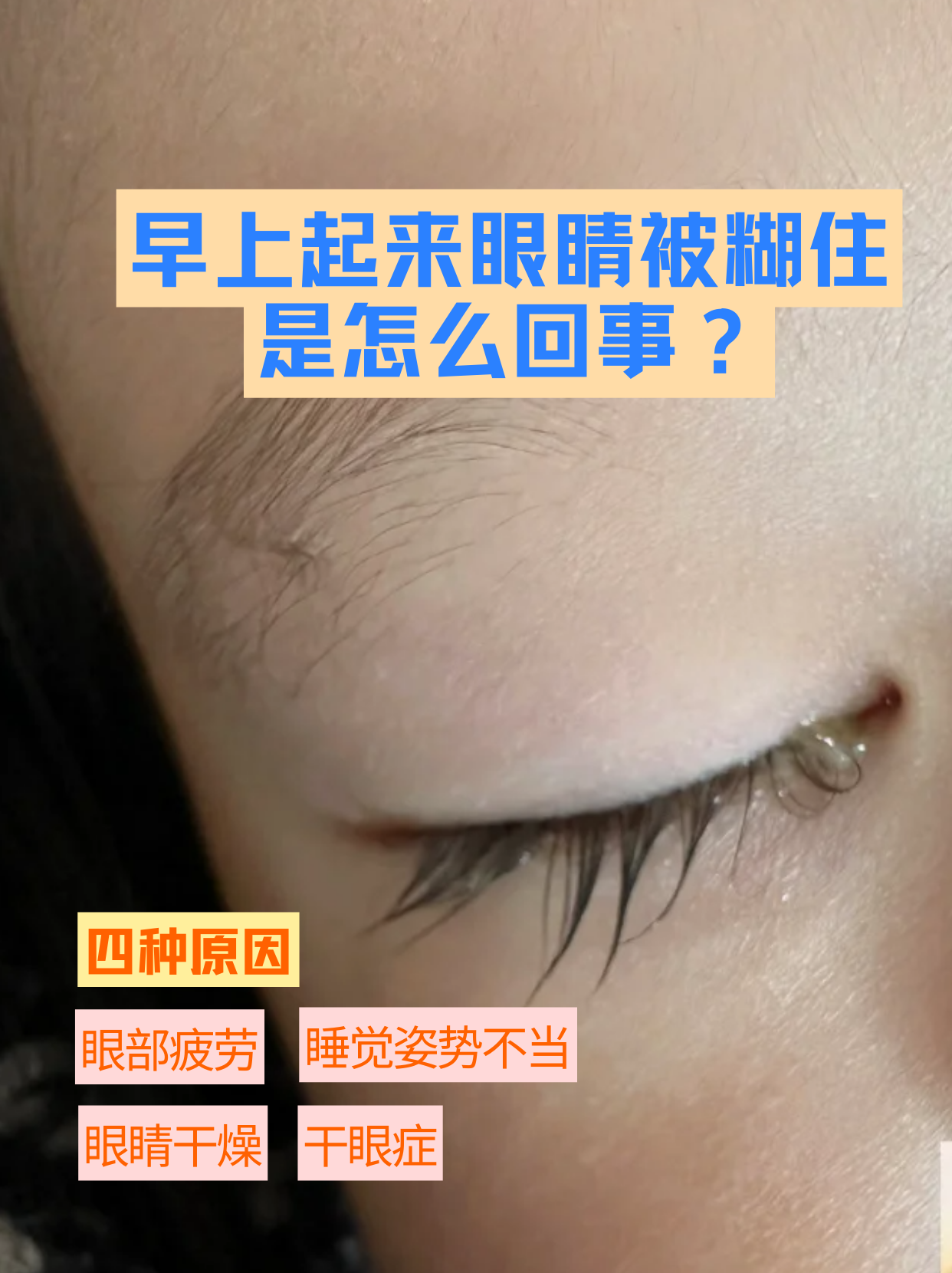 为什么眼睛会模糊