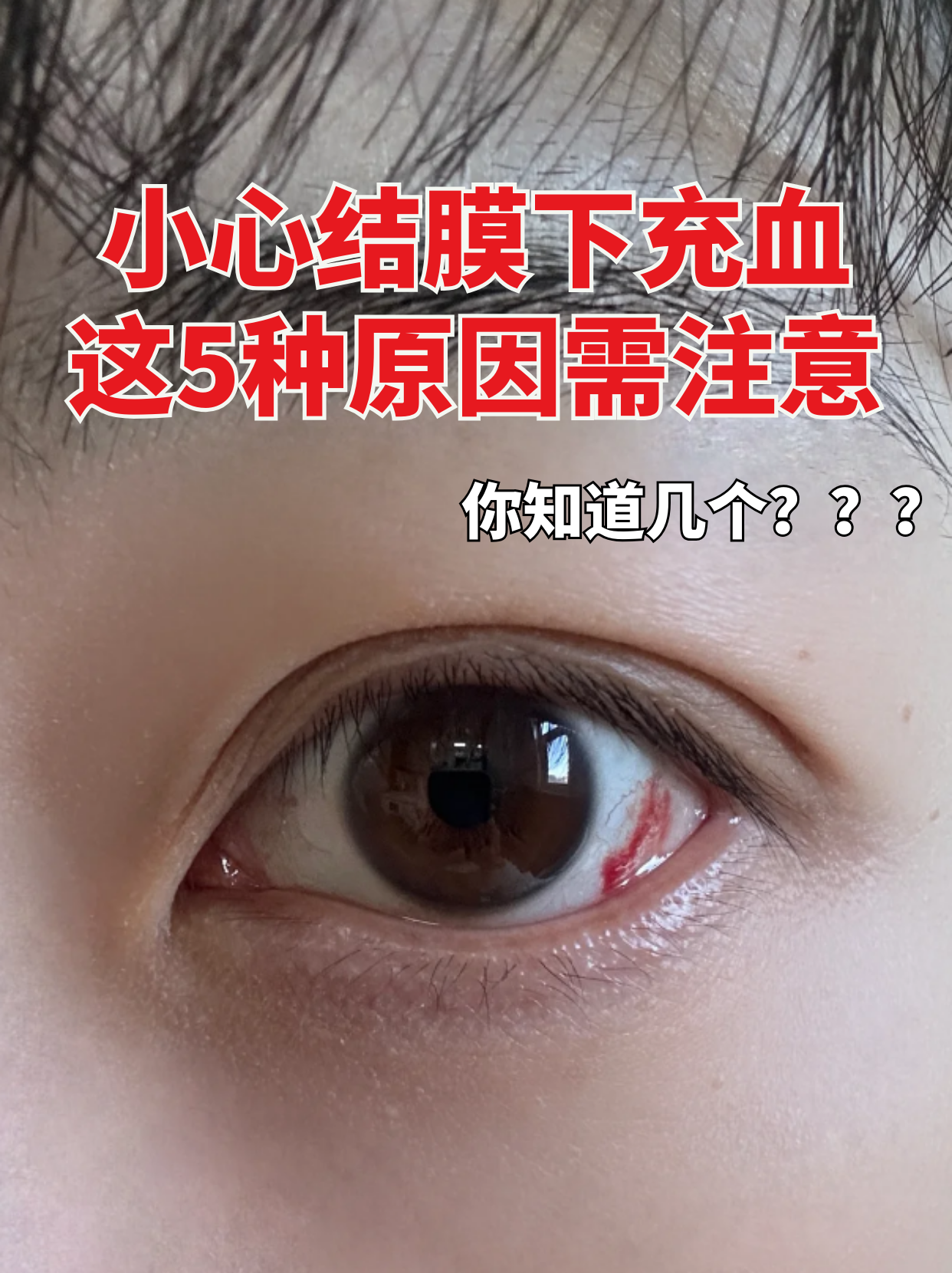 结膜下充血,主要是由于眼表结膜面下的小血管,尤其是毛细血管的破裂