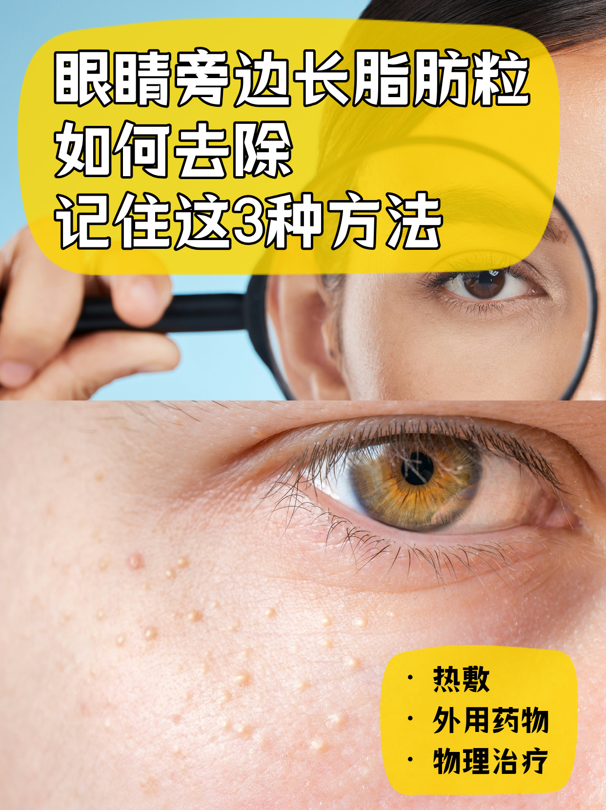 眼睛为什么会长脂肪粒