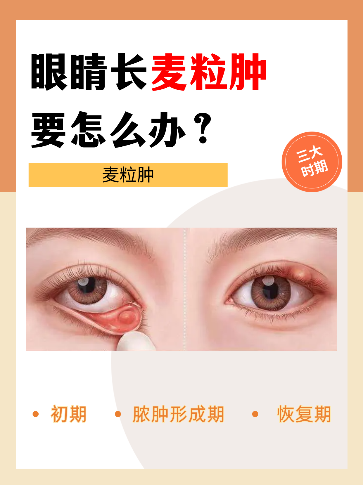 麦粒肿是眼睑腺体的急性化脓性炎症,通常由葡萄球菌感染引起