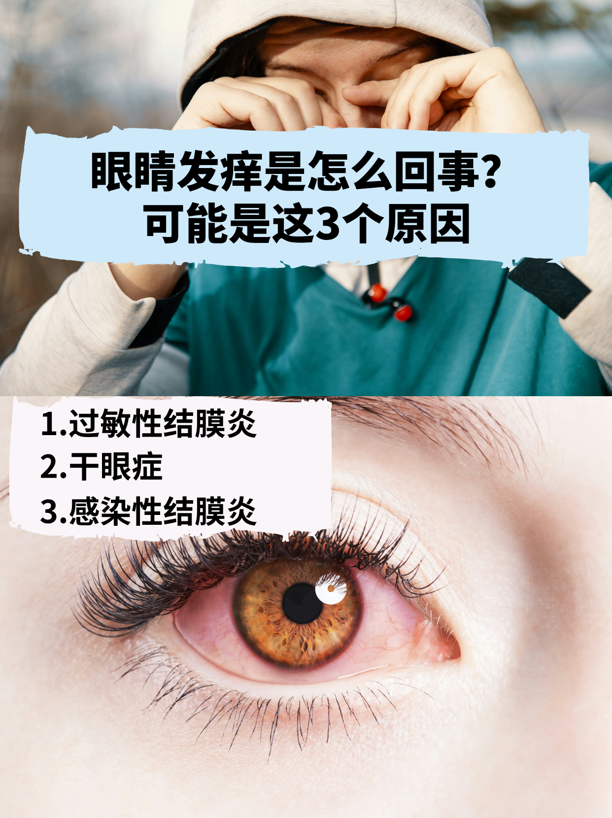 湿疹眼睛为什么会肿