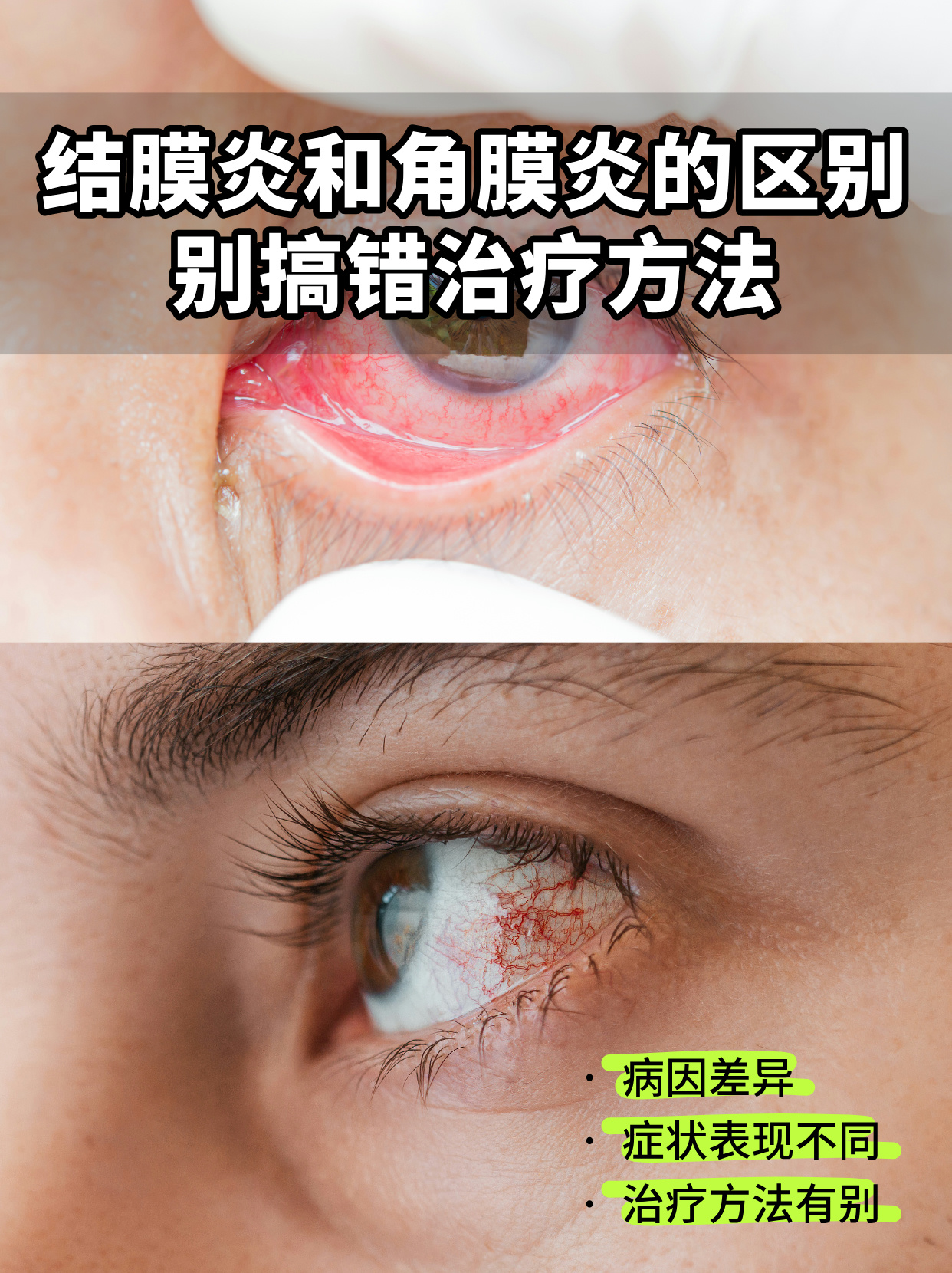 结膜炎和角膜炎的区别,别搞错治疗方法!