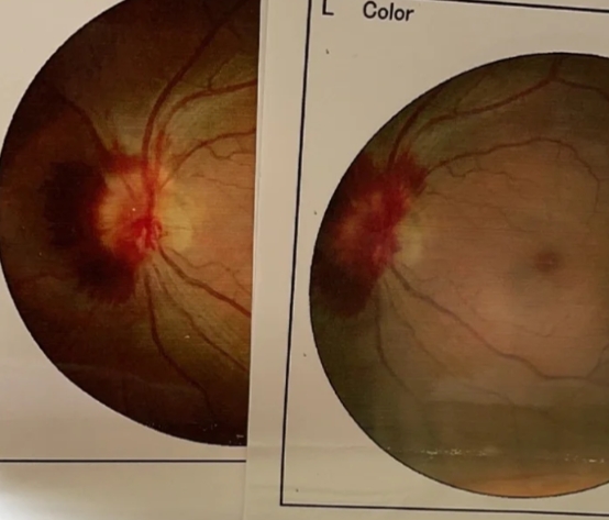 眼底出血,指眼球后壁区域(视网膜,脉络膜等)发生血管破裂导致的血液