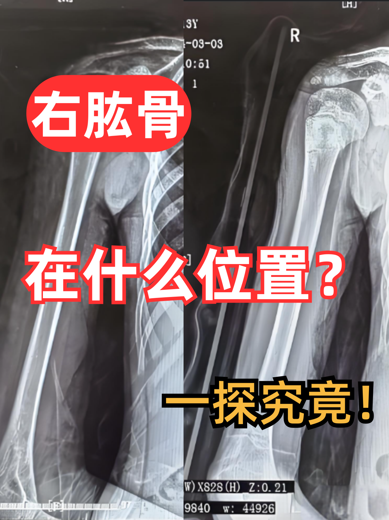 在解剖学上,右肱骨位于人体的右侧肩部和前臂之间,是一块长管状骨