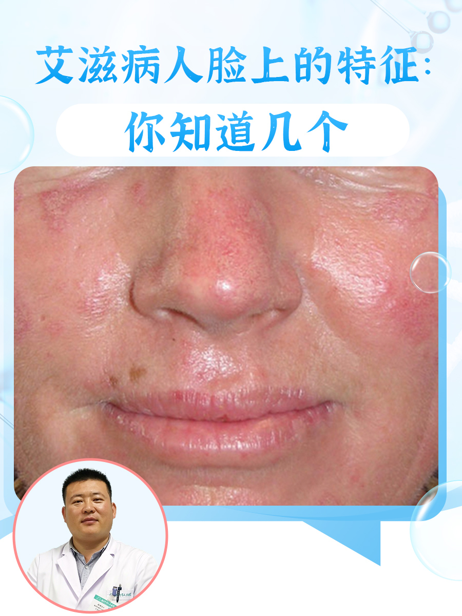 艾滋病人脸上的特征:你知道几个  艾滋病是属于一种感染性疾病,通常是