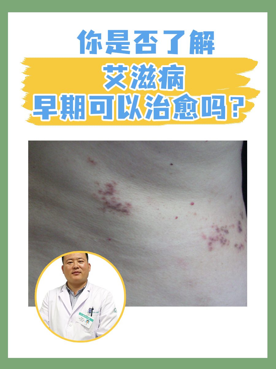 你是否了解:艾滋病早期可以治愈吗?