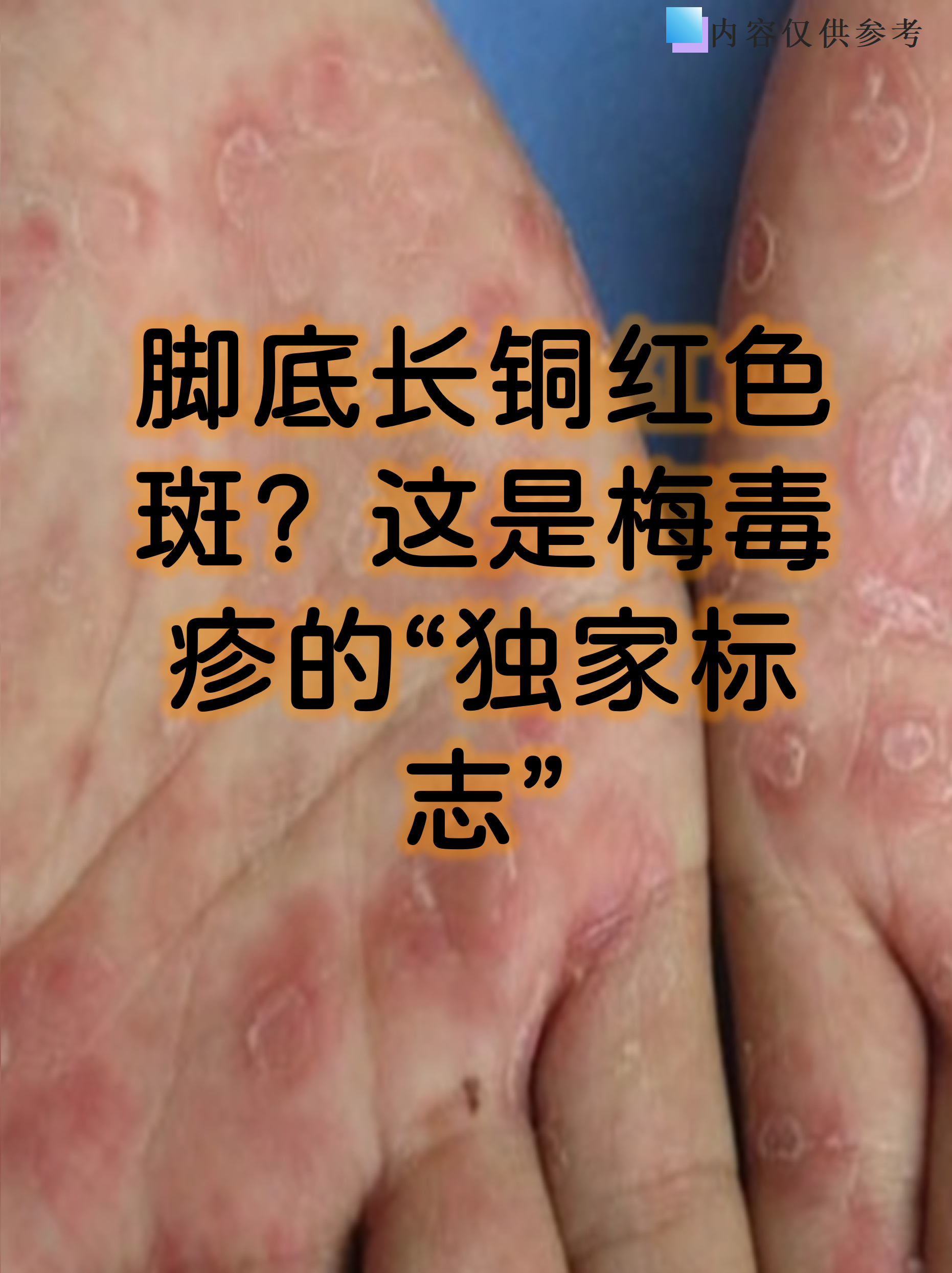 这是梅毒疹的"独家标志"