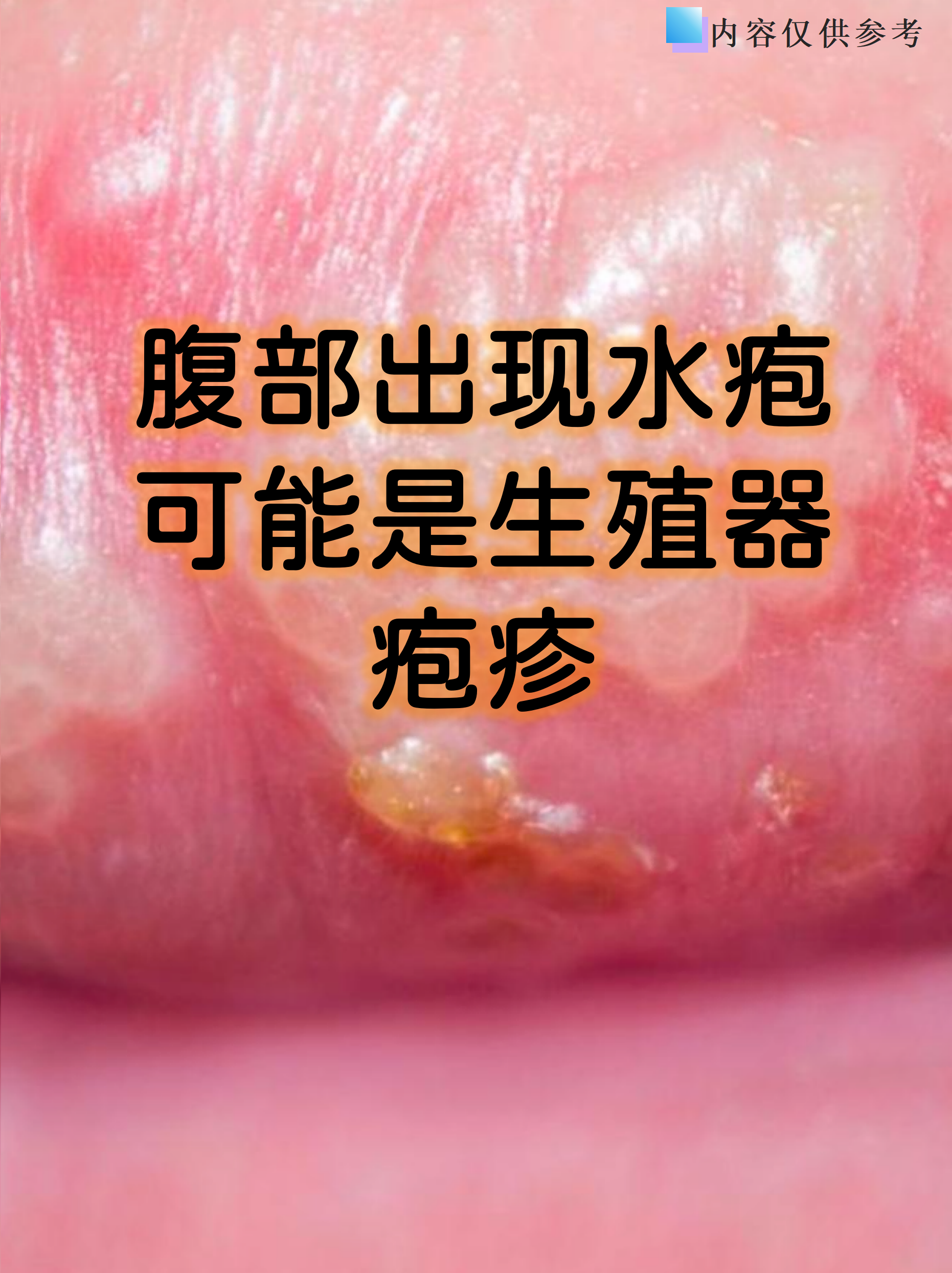 女性为什么会得疱疹会自愈吗为什么在线 女性为什么会得疱疹会自愈吗为什么在线