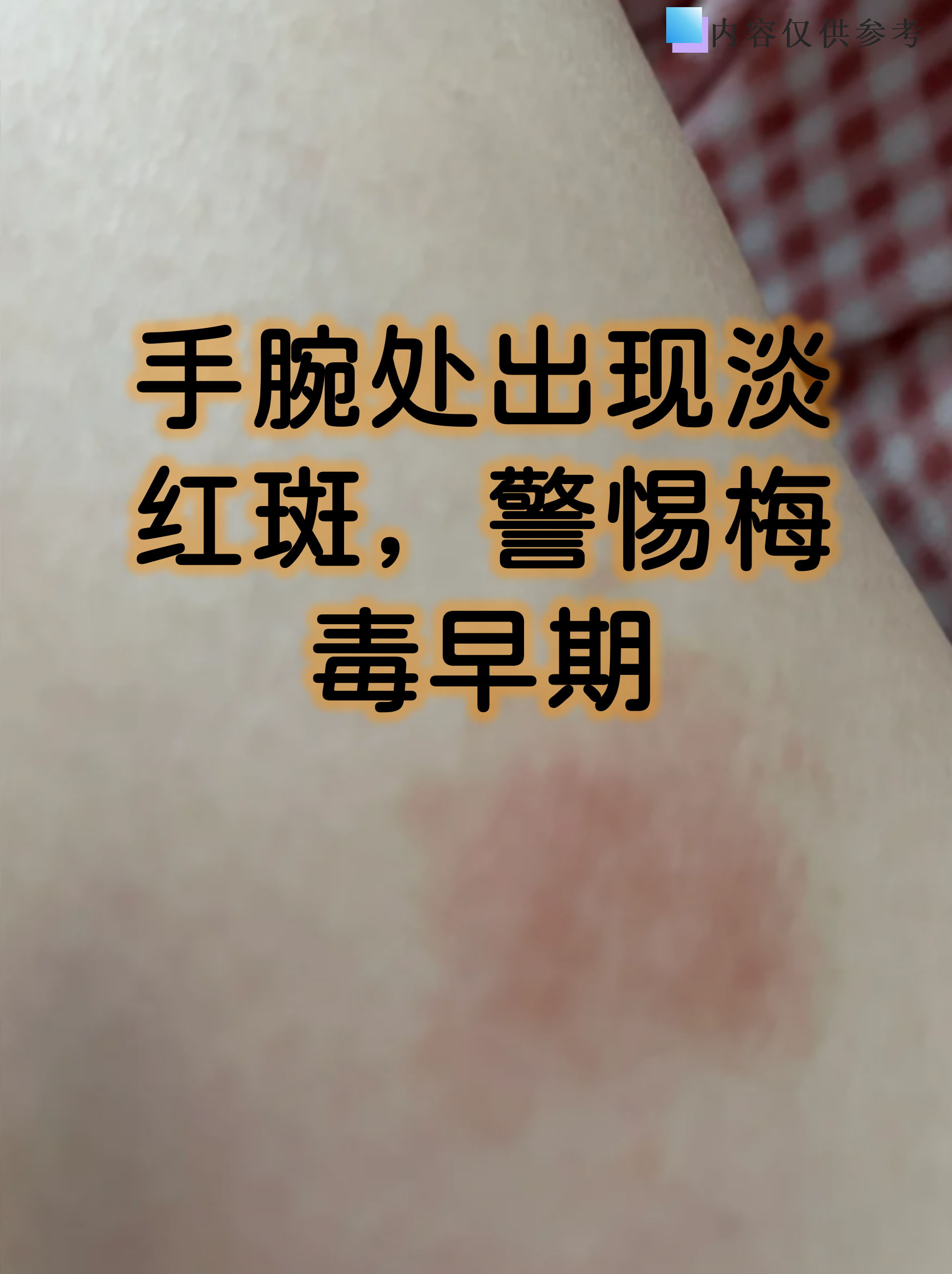 这种皮疹通常不痛不痒,容易被忽视,但及时识别对阻断疾病进展至关重要