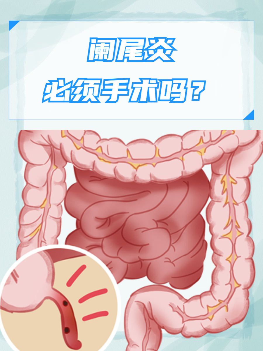 阑尾炎什么症状在哪个部位为什么在线