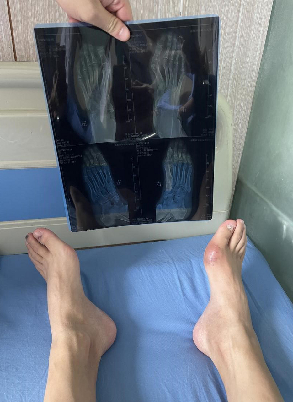 痛风结晶如何消除?