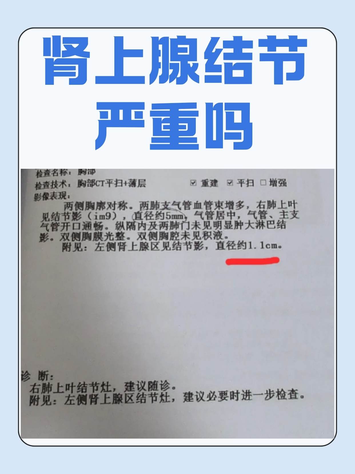 肾上腺结节这一医学术语对许多人来说可能并不