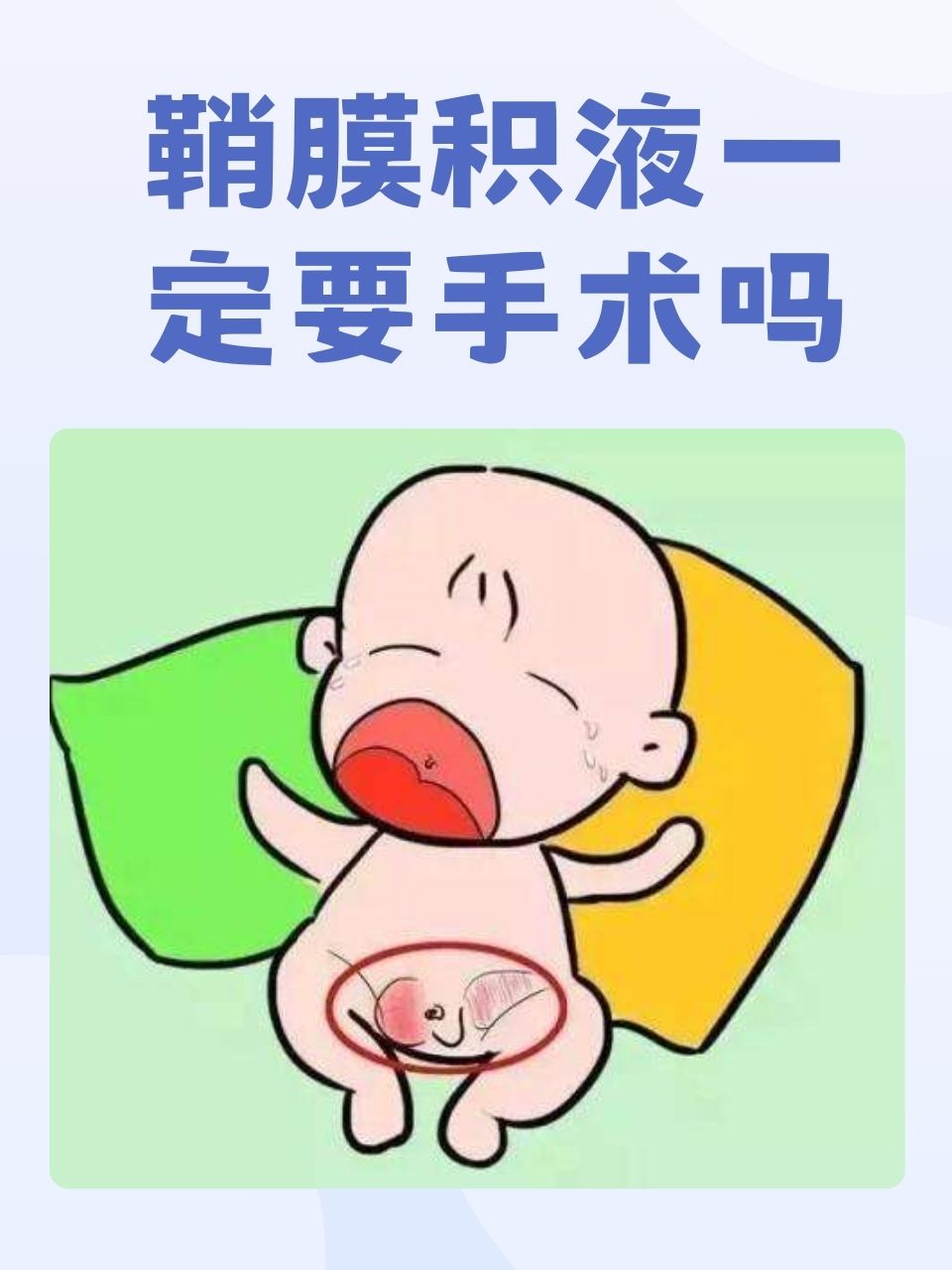 男新生儿鞘膜积液图片图片