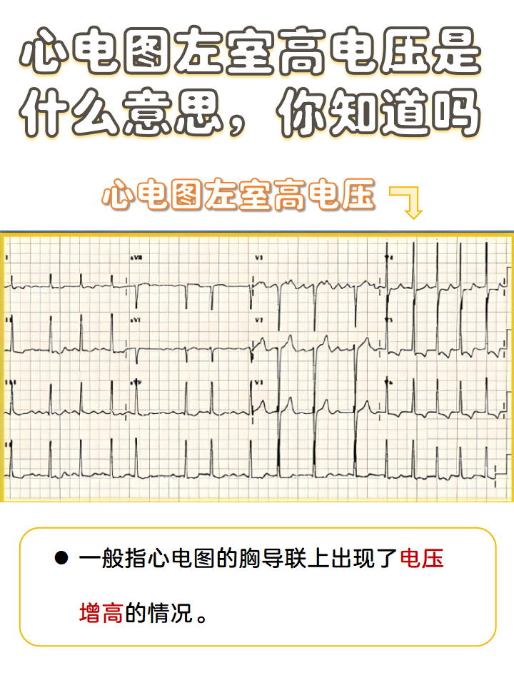 相信大家对心电图并不陌生,而左室高电压就是心电图中的一种表现,那么