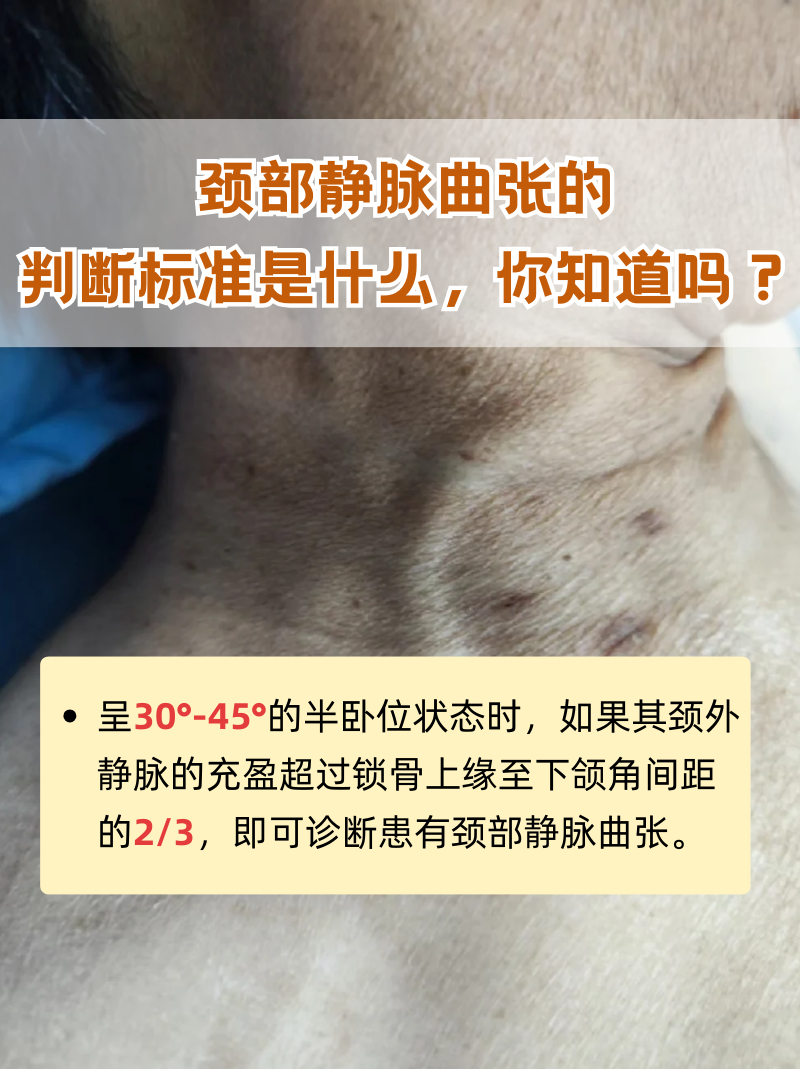 颈部静脉曲张的判断标准是什么,你知道吗?