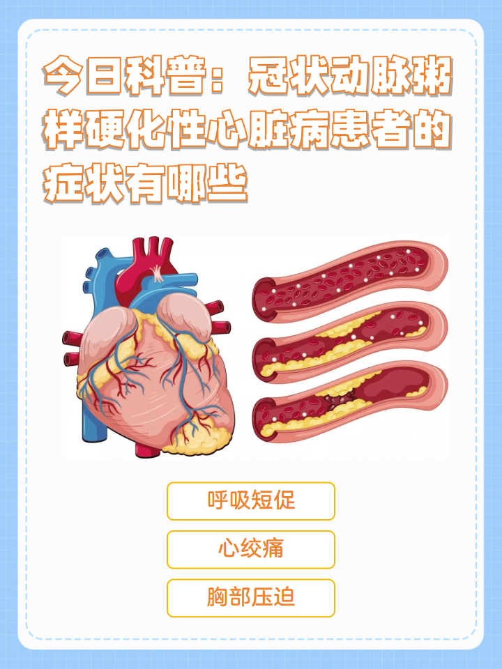 冠状动脉粥样硬化性心脏病是一种临床上常见的心血管疾病,通常与吸烟