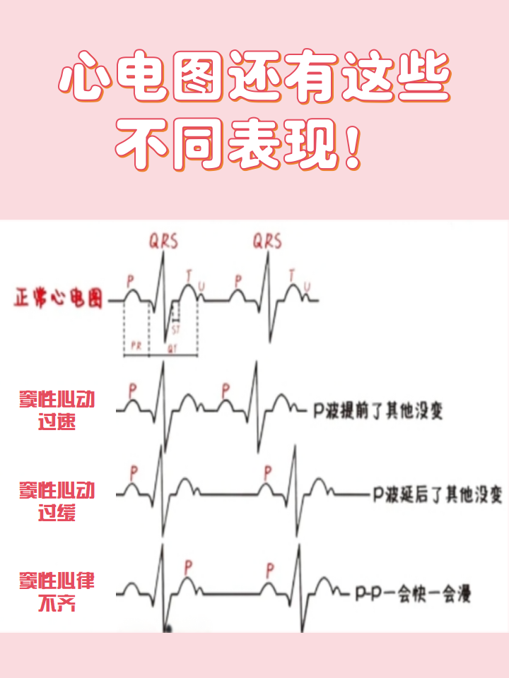 边缘心电图st段抬高是什么原因?