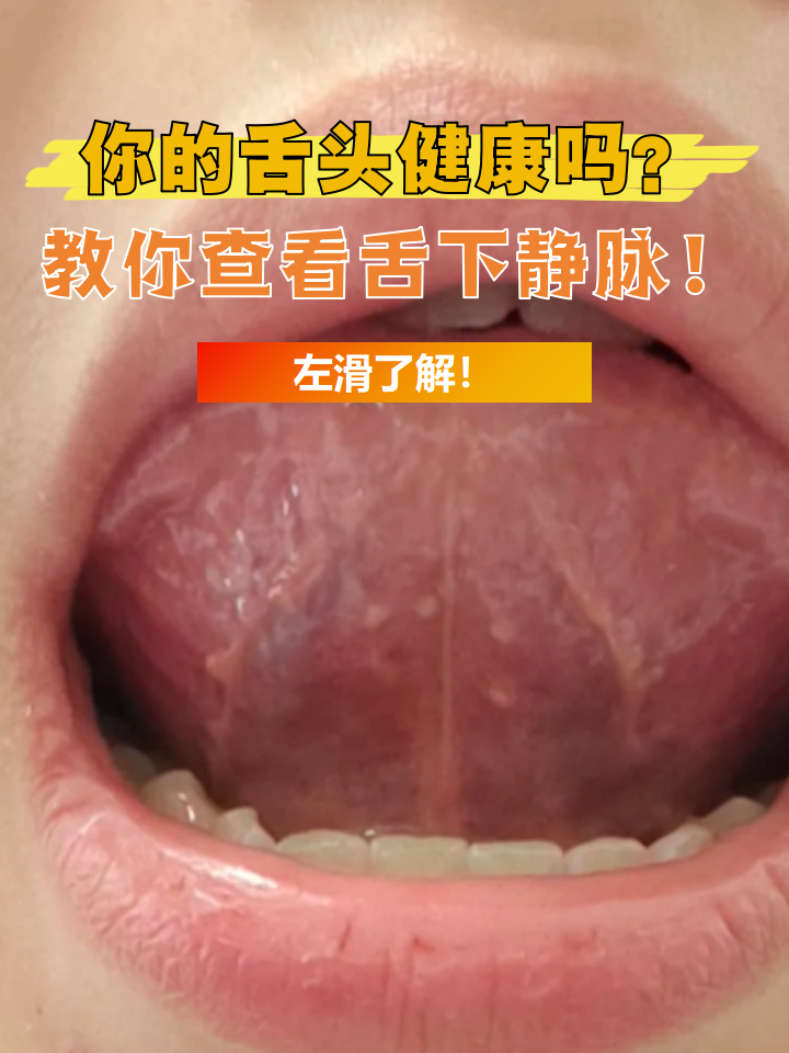 大家知道舌下静脉吗?是舌头下方那些浅浅的紫色线条