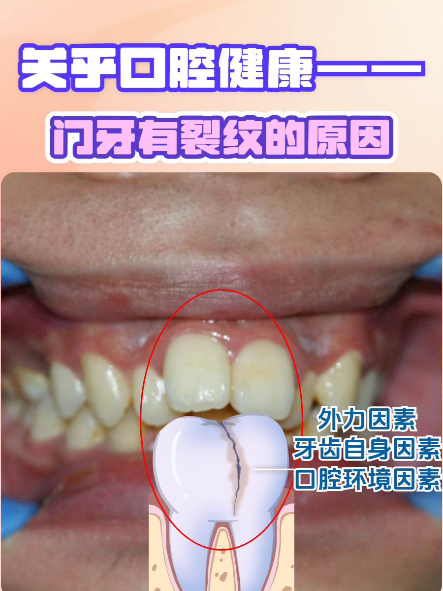 —门牙有裂纹的原因