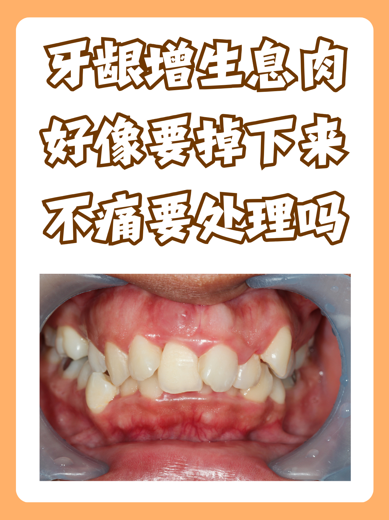 后牙息肉治疗图片