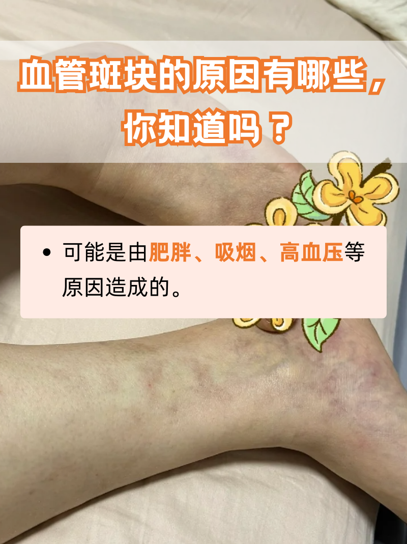 血管斑块是心血管疾病中比较常见的情况