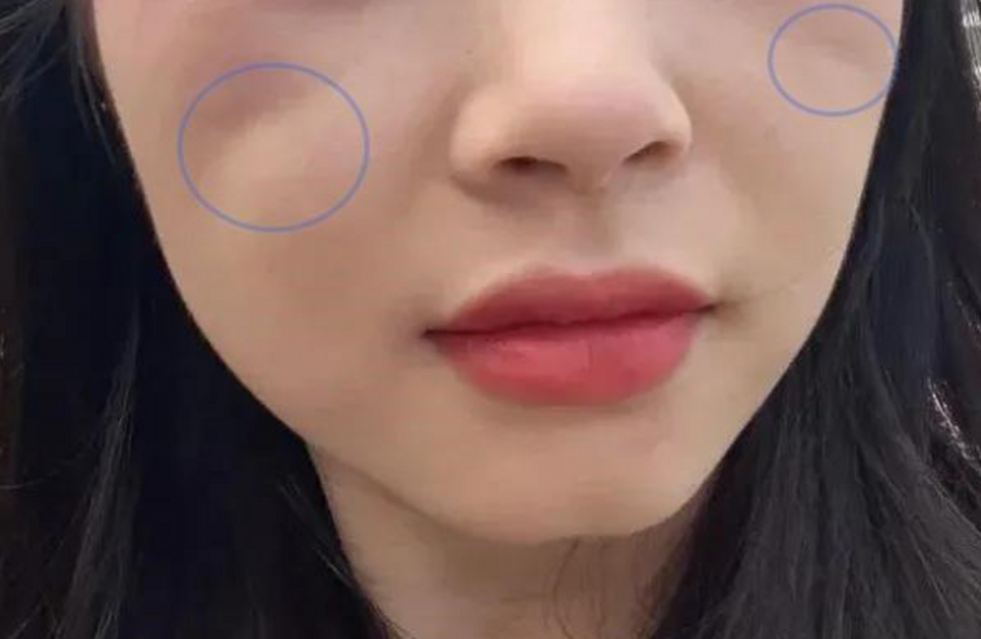 在门诊时会遇到一些患者,在做颧骨手术之后,脸上出现了凹陷