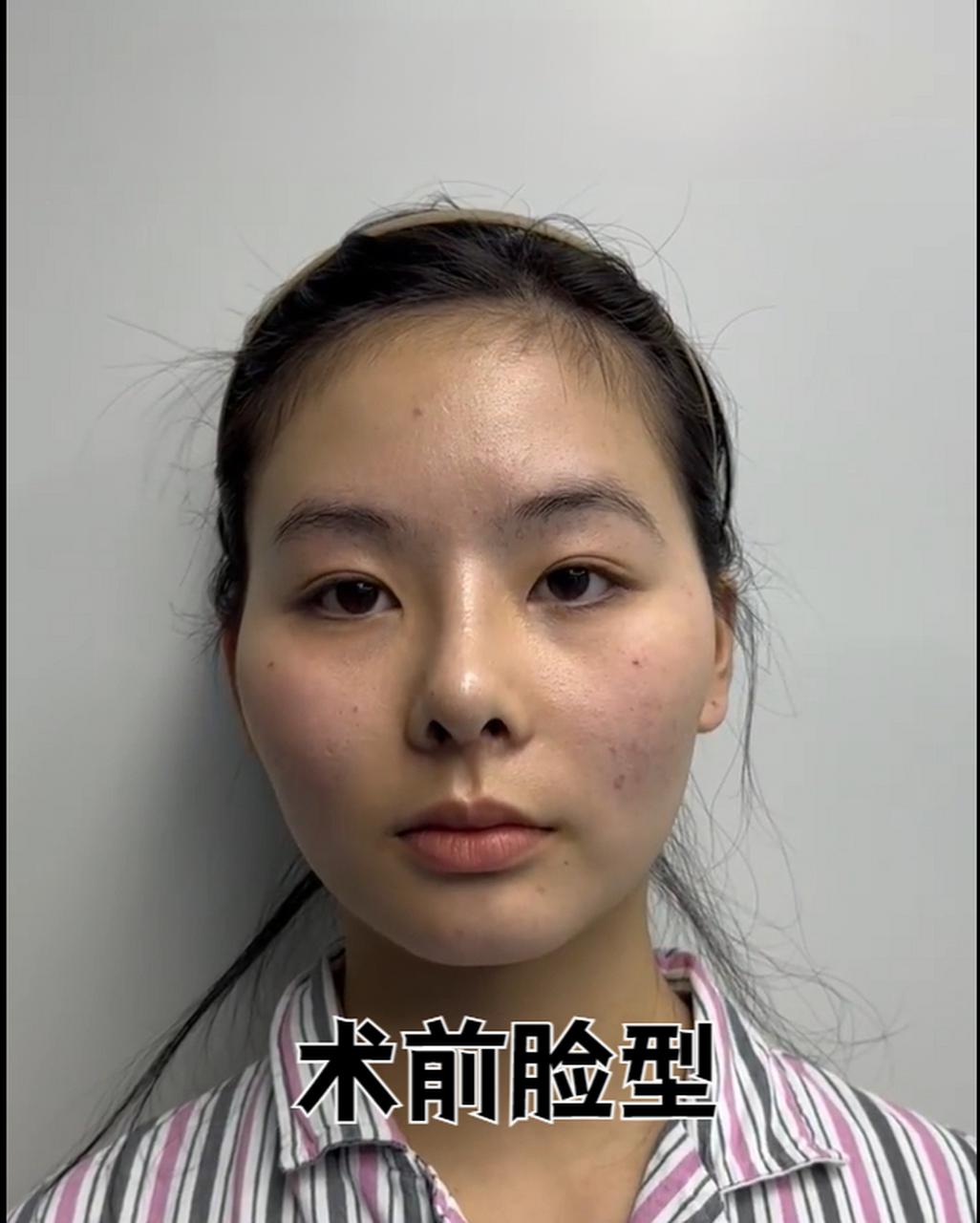 高颧骨也分各种类型? 1