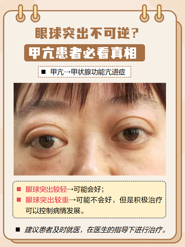 如果眼球突出的情况比较轻,可能会好;如果甲亢突眼甲亢患者眼球突出
