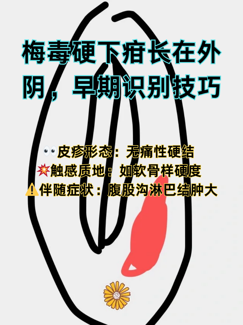 梅毒硬下疳长在外阴,早期识别技巧