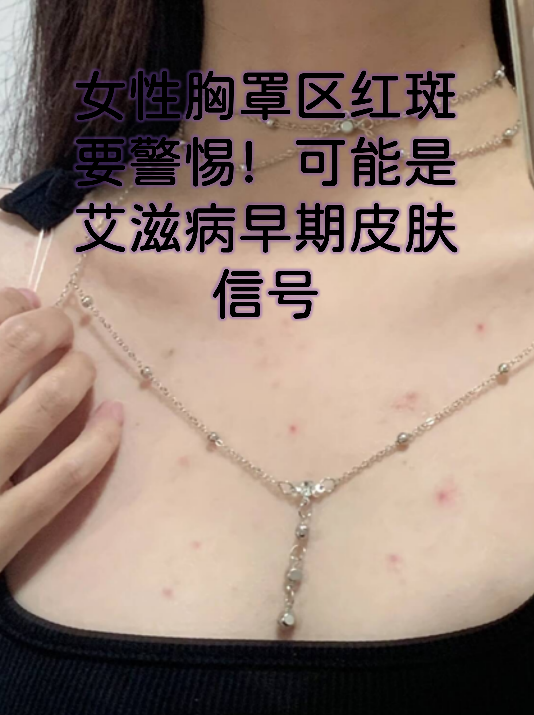可能是艾滋病早期皮肤信号