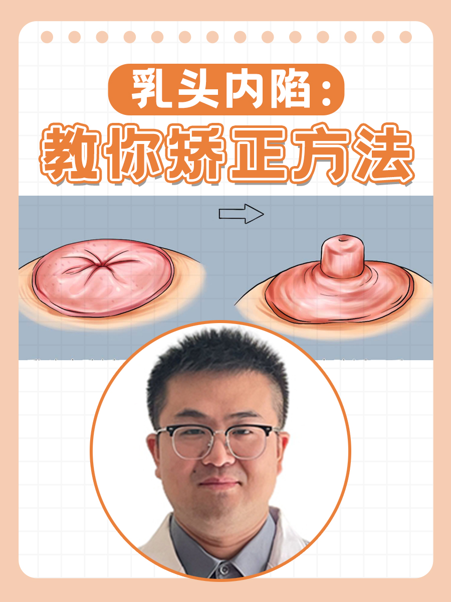 乳头内陷:教你矫正方法
