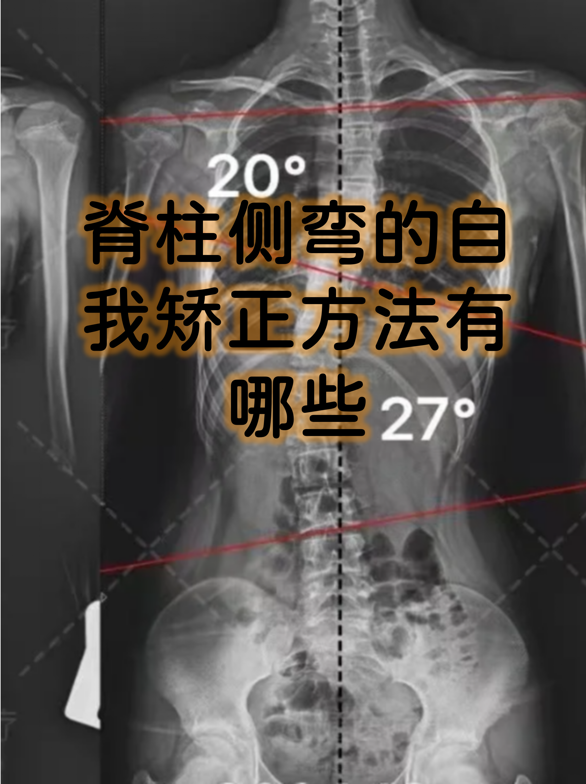 脊柱侧弯的自我矫正方法有哪些
